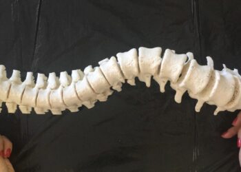 Laboratório goiano trabalha com réplica 3D que revoluciona cirurgias de coluna