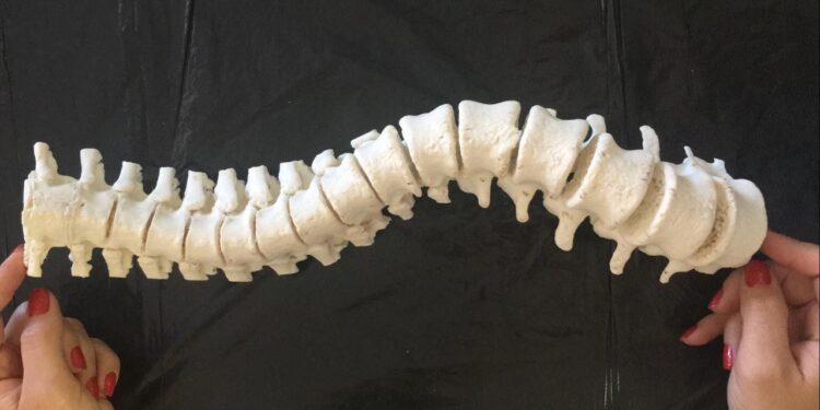 Laboratório goiano trabalha com réplica 3D que revoluciona cirurgias de coluna