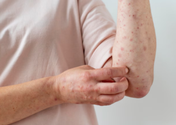 Anvisa recebe pedido de registro para teste de varíola dos macacos