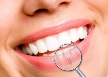 Mercado de implantes deve chegar a R$ 72 milhões em 2027