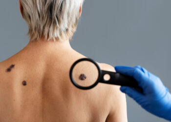 Dezembro Laranja: ICP fará avaliação gratuita de câncer de pele